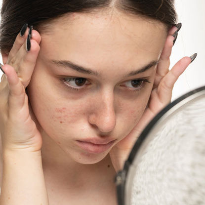 Eine junge Frau mit unreiner Haut betrachtet sich nachdenklich im Spiegel und berührt ihr Gesicht mit beiden Händen. Sie wirkt besorgt über ihre Hautprobleme.